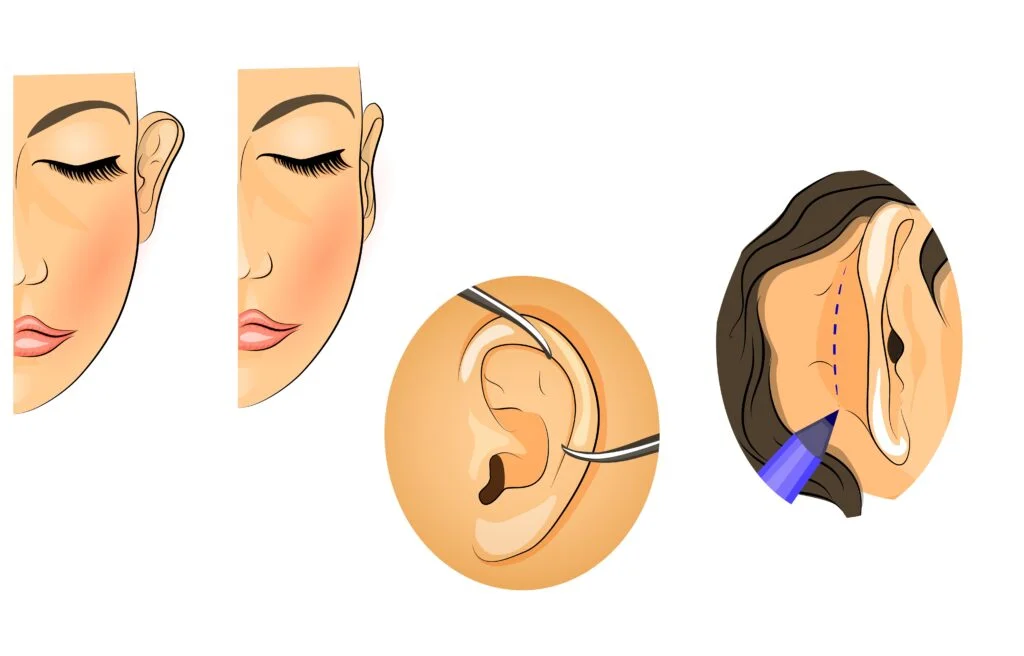 Ilustração da cirurgia para orelha de abano