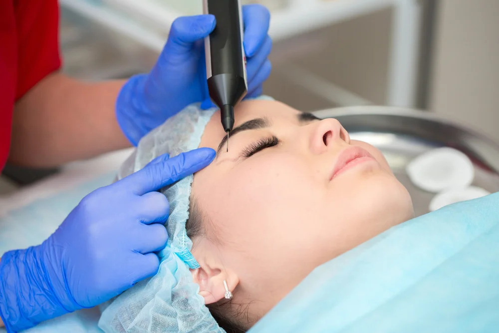 Técnicas de Blefaroplastia Sem Corte