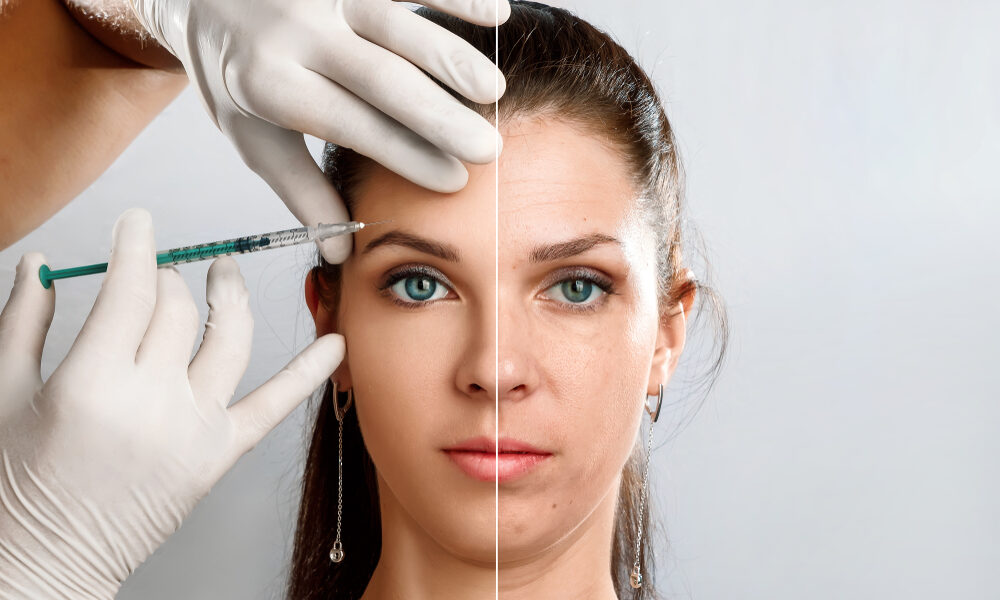 Rosto feminino antes e depois da harmonização facial